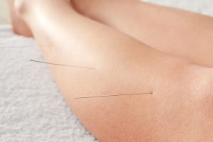 beneficios-de-la-acupuntura-para-la-artrosis