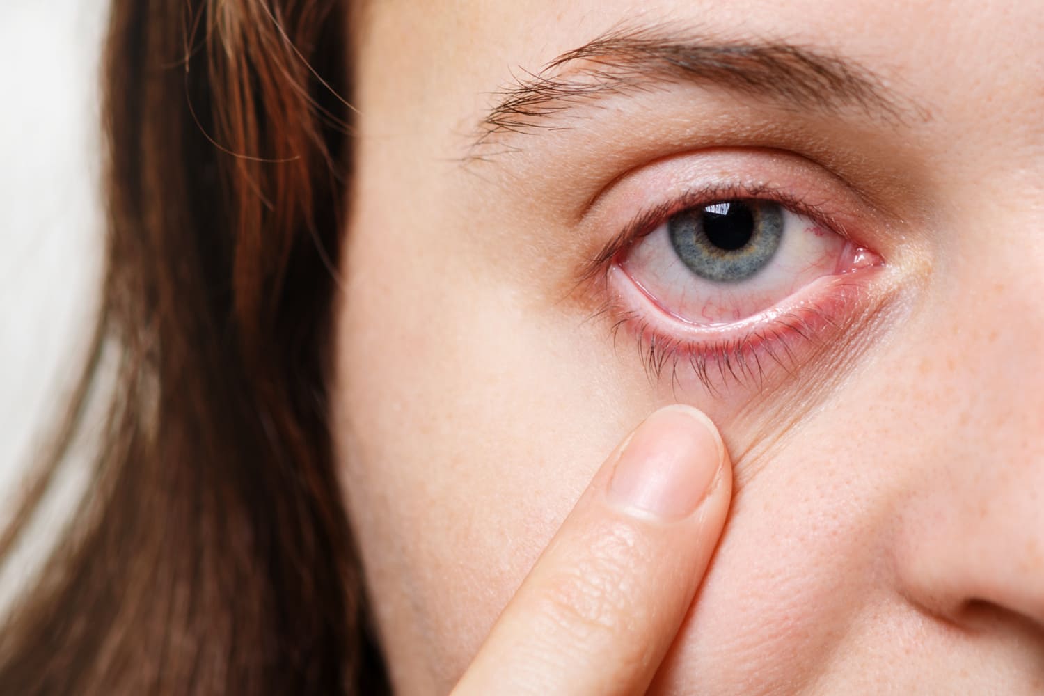 espondiloartritis-ojos-irritados-dolor-no-solo-en-articulaciones