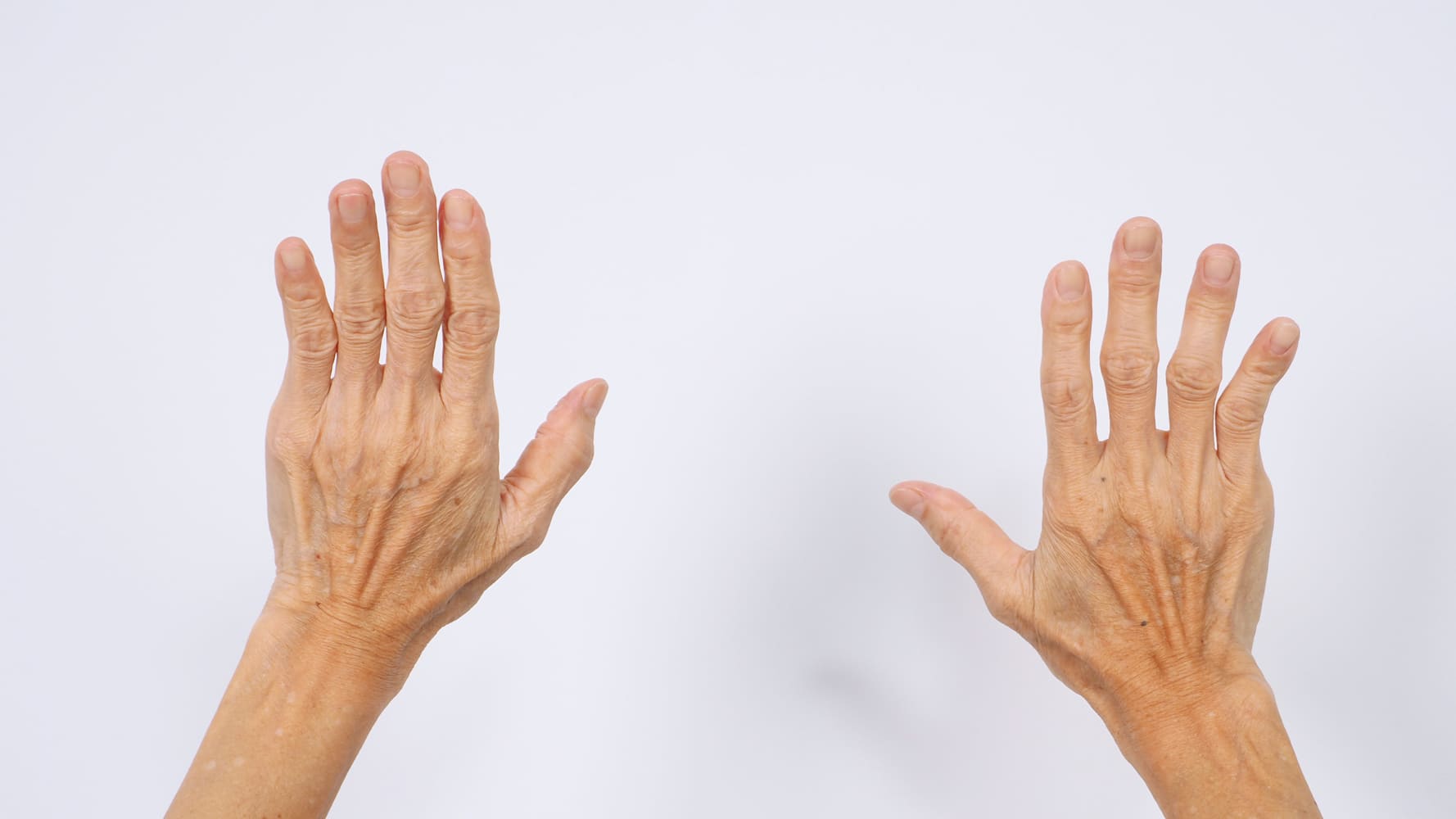 manos-deformes-por-artritis-avanzada